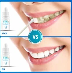 B-care Tanden Bleker – Wittere Tanden – Teeth Whitening Strips – Professioneel Resultaat - Tandsteen Verwijderaar - Zonder Peroxide - Tandenbleekset - Tanden Bleken -BaByliss Verkoopwinkel 1177x1200 4