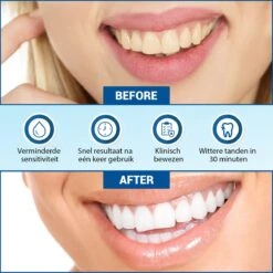 V-Goods Premium Whitening Strips - Tandenbleek Strips - Wittere Tanden - 28x Tandenbleek Strips DIRECT Resultaat - Tandenbleekset - Whitening - Tandenblekers 12 V-Goods Premium Whitening Strips - Tandenbleek Strips - Wittere Tanden - 28x Tandenbleek Strips DIRECT Resultaat - Tandenbleekset - Whitening - Tandenblekers -BaByliss Verkoopwinkel 1200x1199 5