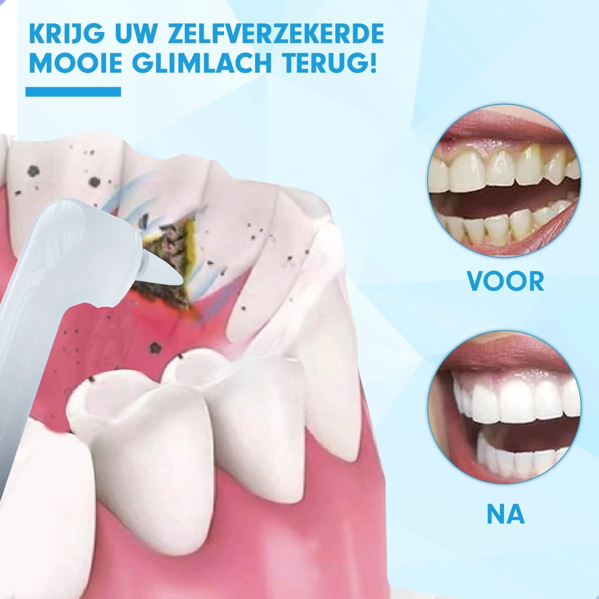 DEN-T® PRO P350 Elektrische Tandenpolijster - Wit - 5 Standen - 5 Opzetstukken - Polijstmachine - Polijstset - Tanden Polijsten - - Afbeelding 5