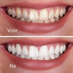 Witte Tanden Kleur Corrector - Superdeal - 1 + 1 GRATIS - Kleur Tanden Wit Door Te Poetsen Thuis - Tanden Bleken - Tanden Witte - Foam Voor Witte Tanden -BaByliss Verkoopwinkel 1200x1200 916