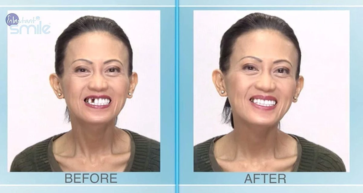 Tand Afgebroken Reparatie Kit InstantSmile Gebit (goedkope Kunstgebit) - Multi Shade - Afbeelding 4