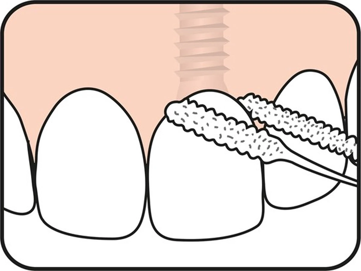 Tepe Floss Bridge & Implant 30 St 11 Tepe Floss Bridge & Implant 30 St - Afbeelding 9